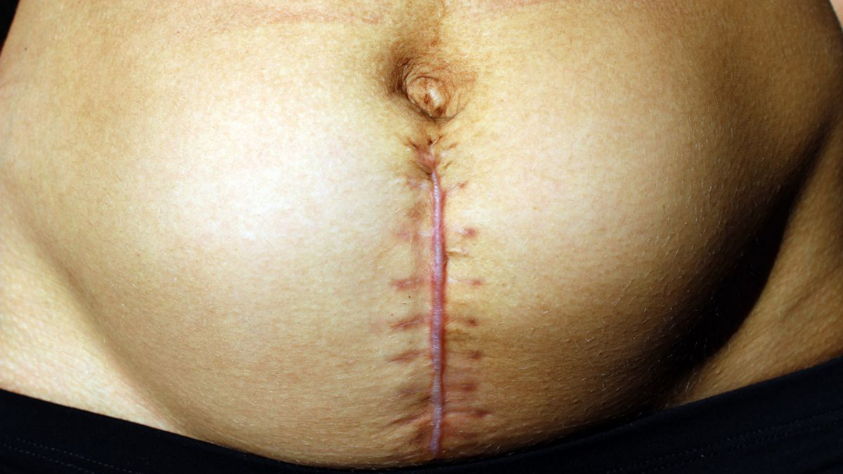 15 Things I Wish Somebody Told Me About C-Sections