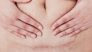 15 Things I Wish Somebody Told Me About C-Sections