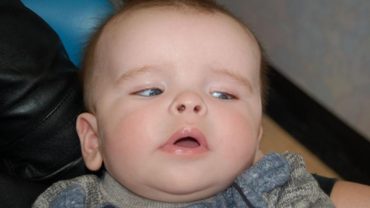 Macrocephaly in Babies: Causes, Diagnosis, and Treatment