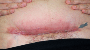 C -Section Scar Infection! Symptoms, Causes And Prevention